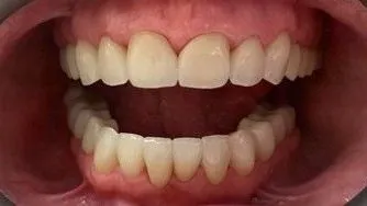 LoudounDentistry_Crowns_After_1-af142104-1920w