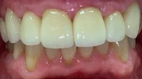 LoudounDentistry_Crowns_After_2-acba95e4-1920w