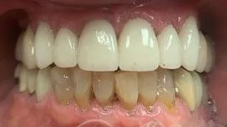 LoudounDentistry_Crowns_After_3-483d778e-1920w