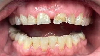 LoudounDentistry_Crowns_Before_1-226785d9-1920w