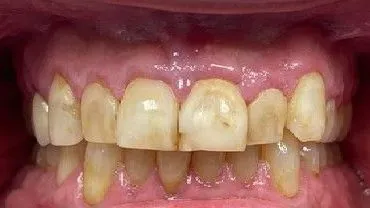 LoudounDentistry_Crowns_Before_2-a471be74-1920w