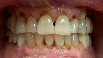 LoudounDentistry_Crowns_Before_3-9553b5c0-1920w