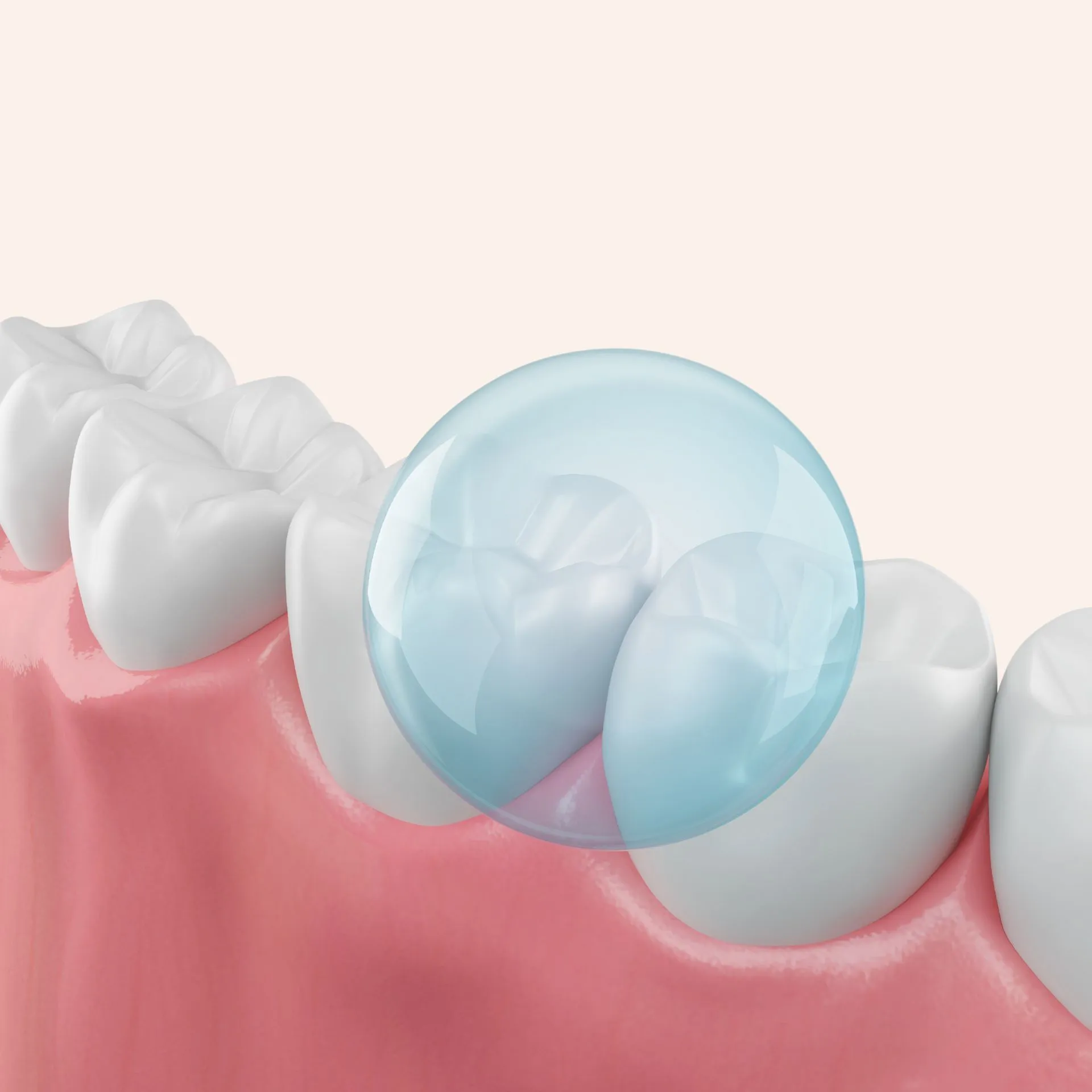 Patient receiving fluoride treatment at Loudoun Family and Cosmetic Dentistry for stronger teeth