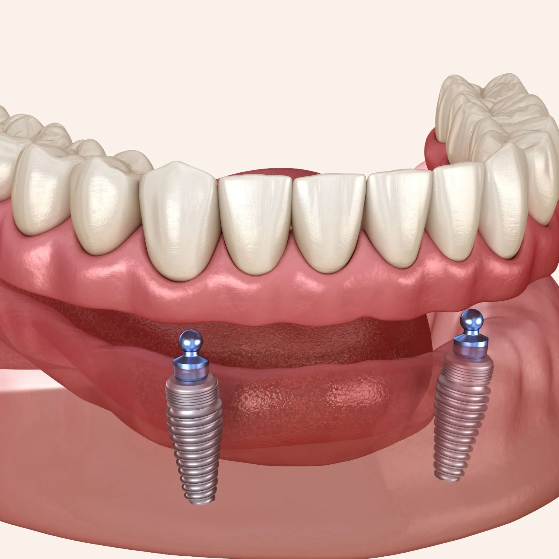High-quality dentures for tooth replacement at Loudoun County cosmetic dental office