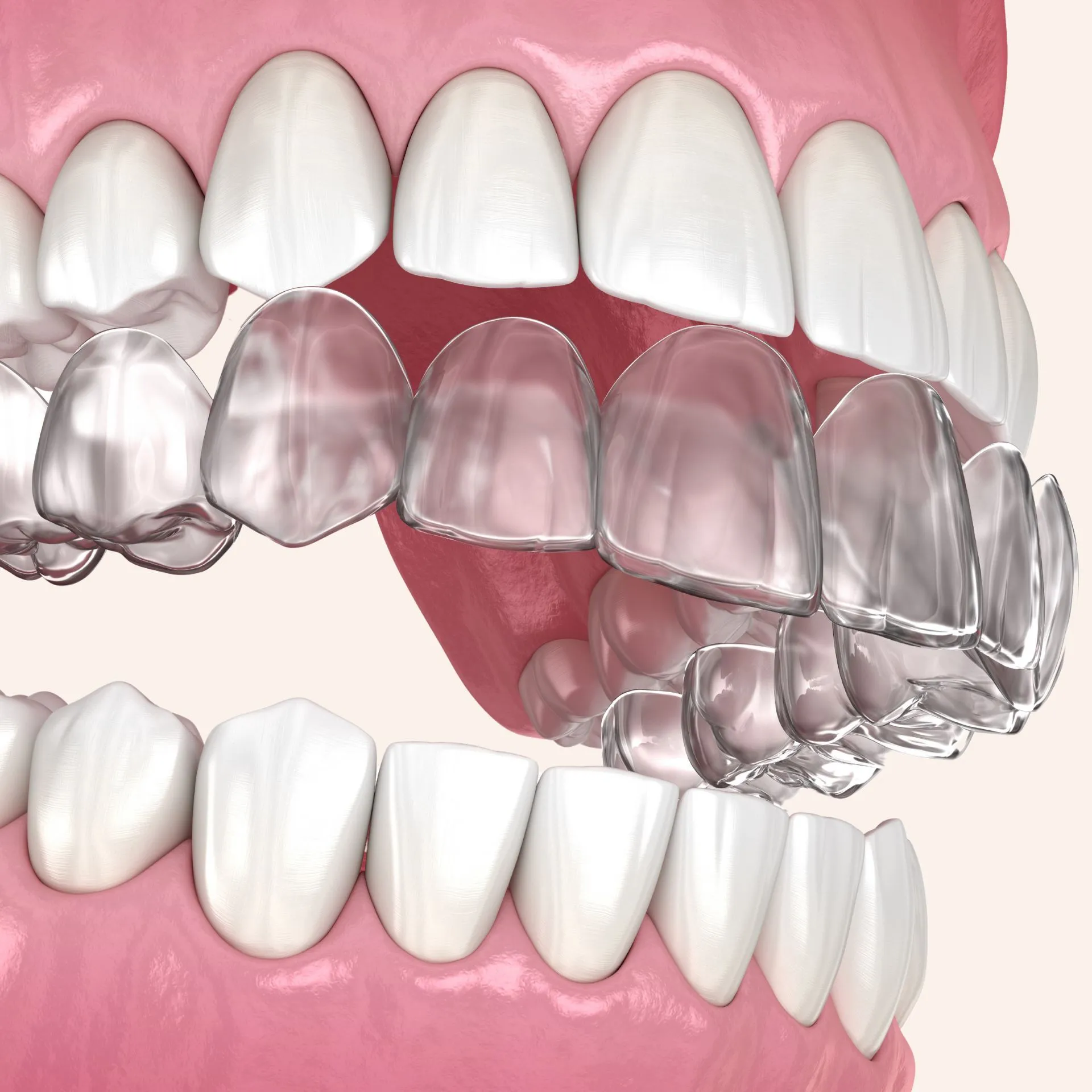 Discreet Invisalign trays used by Loudoun cosmetic dentist to align teeth without braces