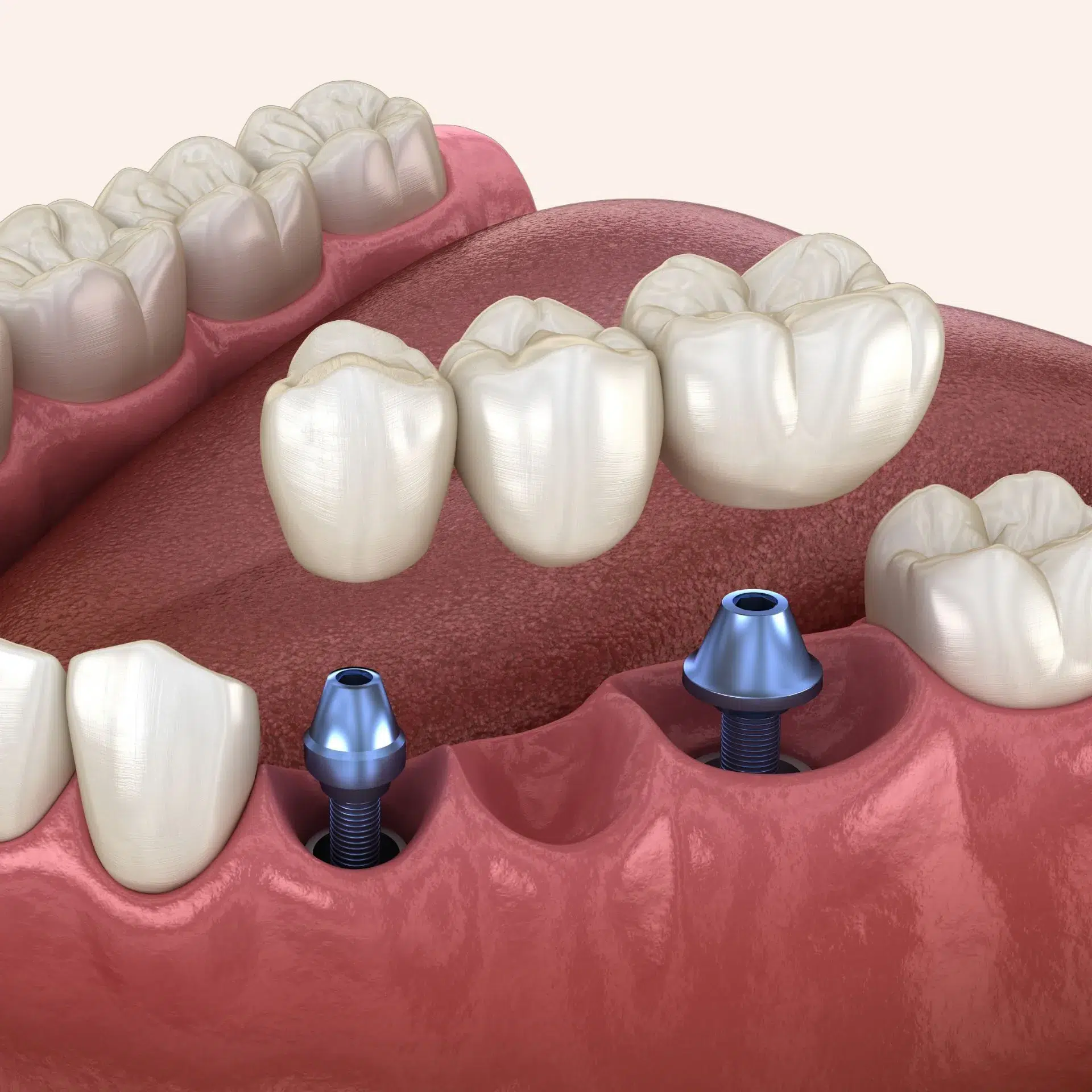 Dental model showing multiple teeth implants restoring several missing teeth at Loudoun Family & Cosmetic Dentistry in Leesburg, VA Dental model showing multiple teeth implants restoring several missing teeth at Loudoun Family & Cosmetic Dentistry in Leesburg, VA