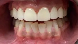 LoudounDentistry_Veneers_After_1-8363cb43-1920w
