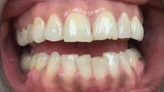 LoudounDentistry_Veneers_Before_1-75ceecb2-1920w