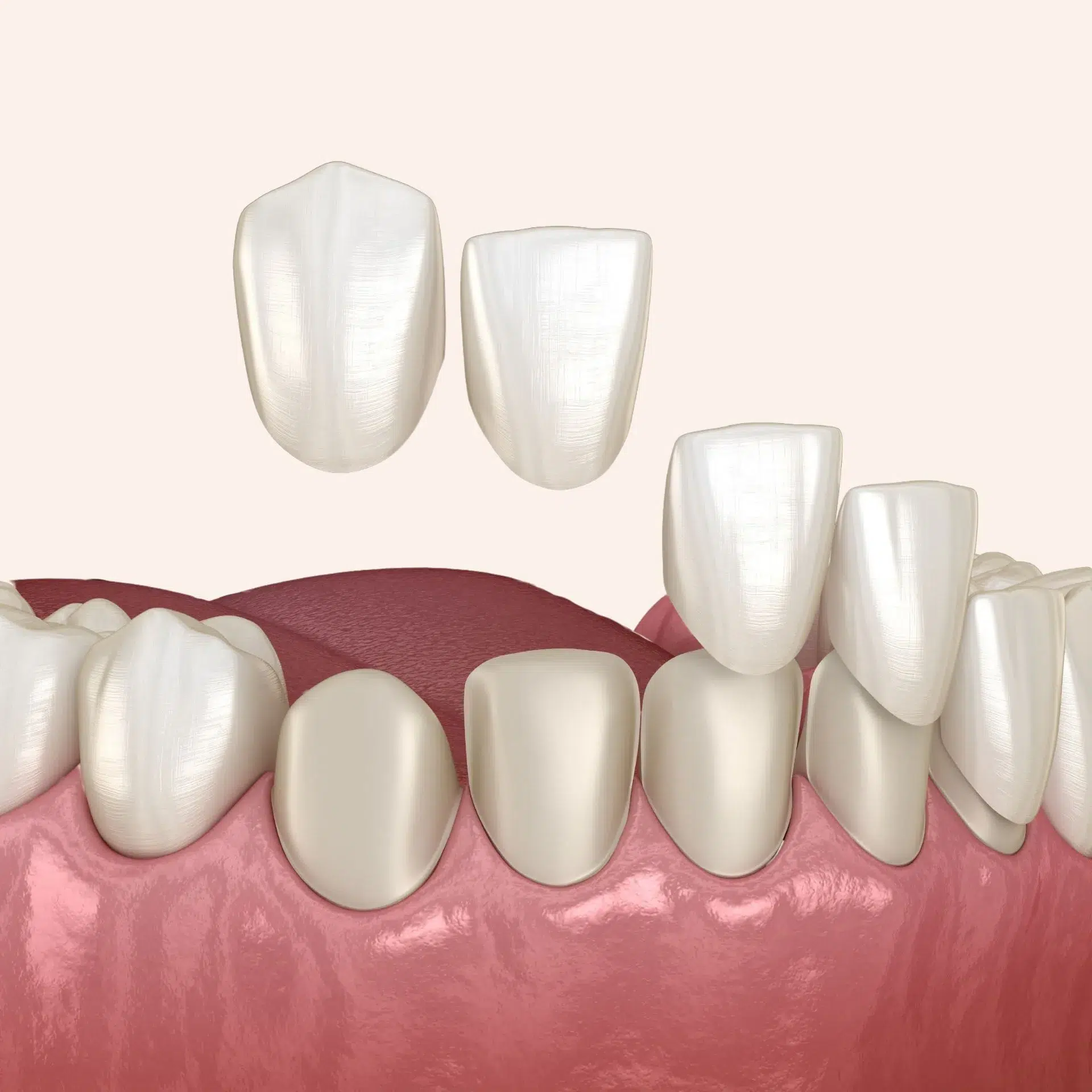 Patient with porcelain veneers for a flawless smile at Loudoun Family and Cosmetic Dentistry