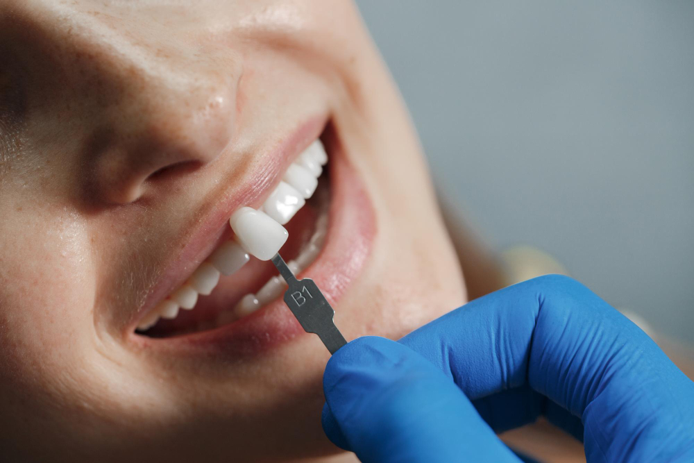 Dental professional matching the shade of a porcelain veneer to a patient’s natural teeth for a seamless cosmetic restoration. Dental professional matching the shade of a porcelain veneer to a patient’s natural teeth for a seamless cosmetic restoration.