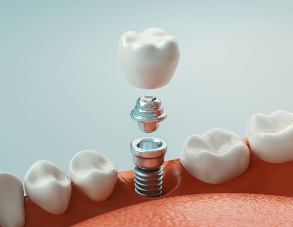 A detailed dental model showing socket preservation and a dental implant. The model illustrates the extraction site with bone graft material placed in the socket, and a titanium implant post positioned to demonstrate how the implant will integrate with the preserved bone for future restoration