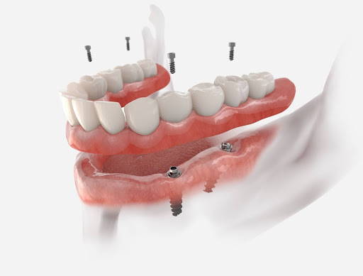 Dental model showing All-on-4 implants supporting a full arch of replacement teeth at Loudoun Family & Cosmetic Dentistry in Leesburg, VA Dental model showing All-on-4 implants supporting a full arch of replacement teeth at Loudoun Family & Cosmetic Dentistry in Leesburg, VA