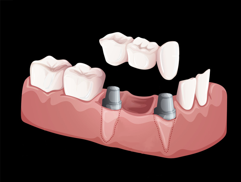 Dental model showing multiple teeth replaced with implant-supported crowns at Loudoun Family & Cosmetic Dentistry in Leesburg, VA Dental model showing multiple teeth replaced with implant-supported crowns at Loudoun Family & Cosmetic Dentistry in Leesburg, VA