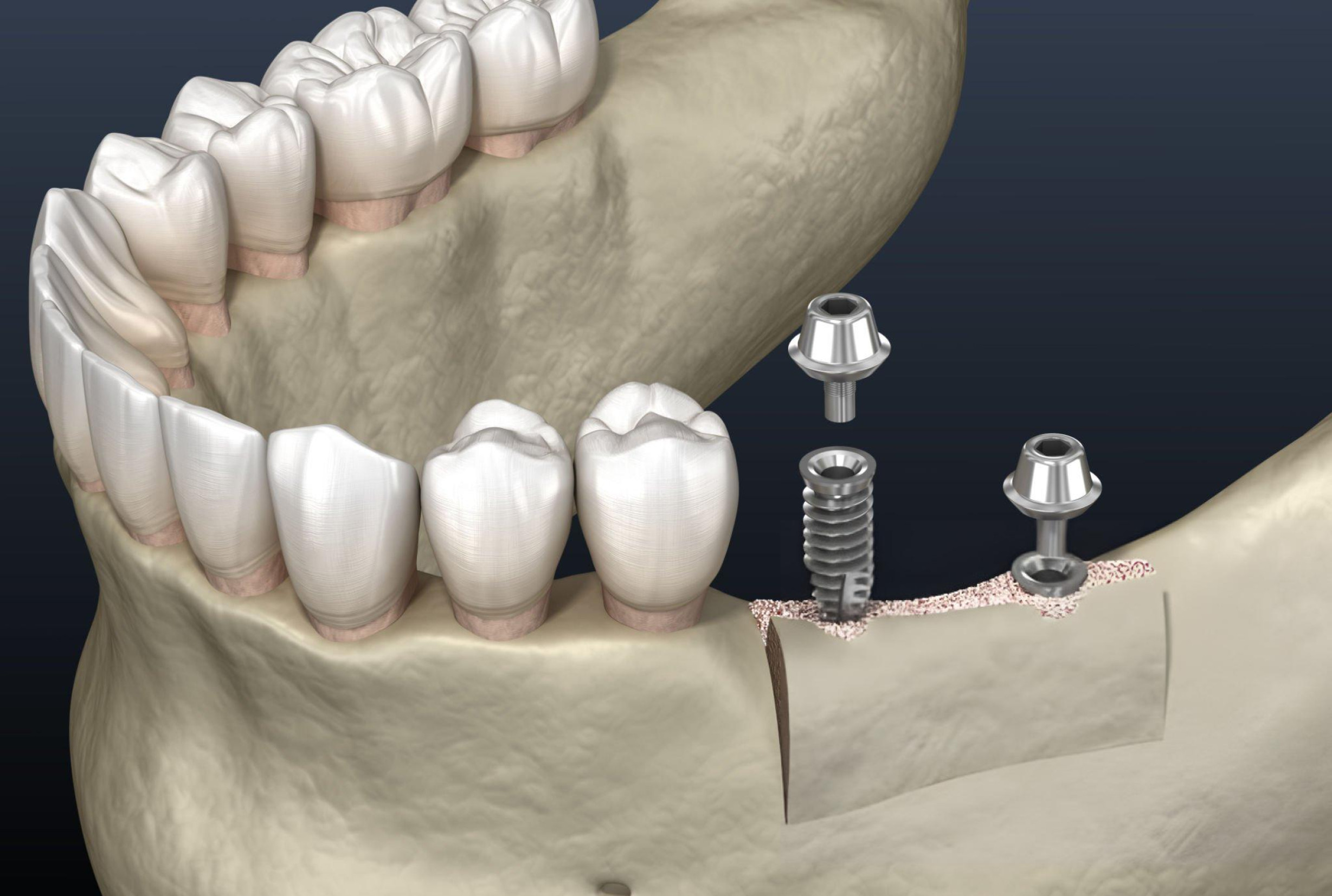 A detailed dental model illustrating ridge augmentation. The model shows a section of the jawbone with areas of horizontal and vertical bone loss being rebuilt.