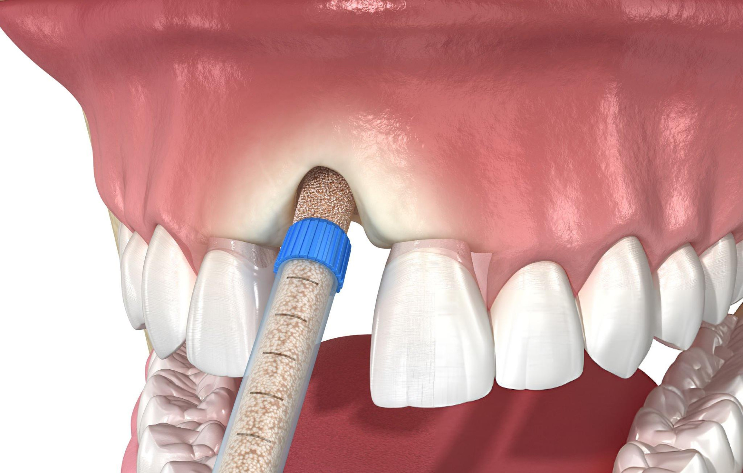 Dental model showing gum preparation techniques at Loudoun Family & Cosmetic Dentistry in Leesburg, VA Dental model showing gum preparation techniques at Loudoun Family & Cosmetic Dentistry in Leesburg, VA
